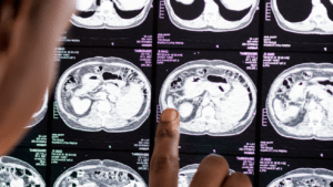 Estou esquecendo nomes das coisas: devo procurar um fonoaudiólogo?